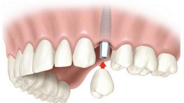Implante Dentário Carga Imediata de um dente