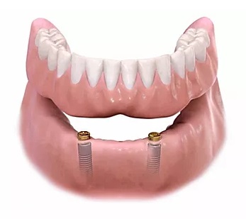 Implantes dentários com o uso de sobre dentaduras ou Ouverdenture