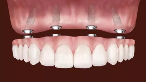 Implantes dentários substituem todos os dentes - Dentadura - Protocolo