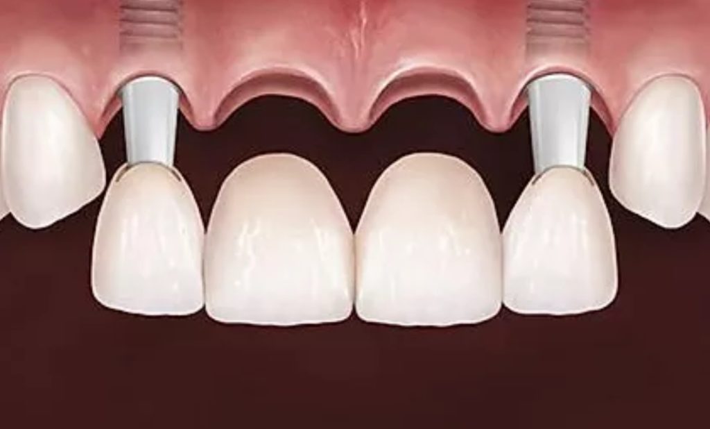 Implantes dentários substituem vários dentes