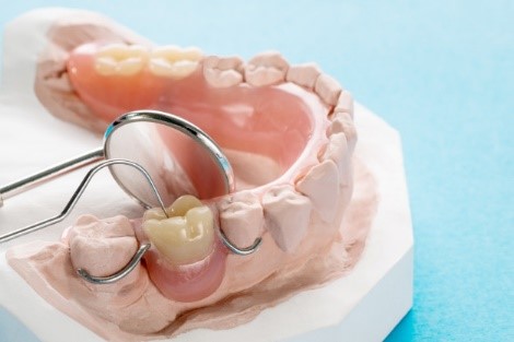Preço dos implantes Dentários opcoes mais baratas 1